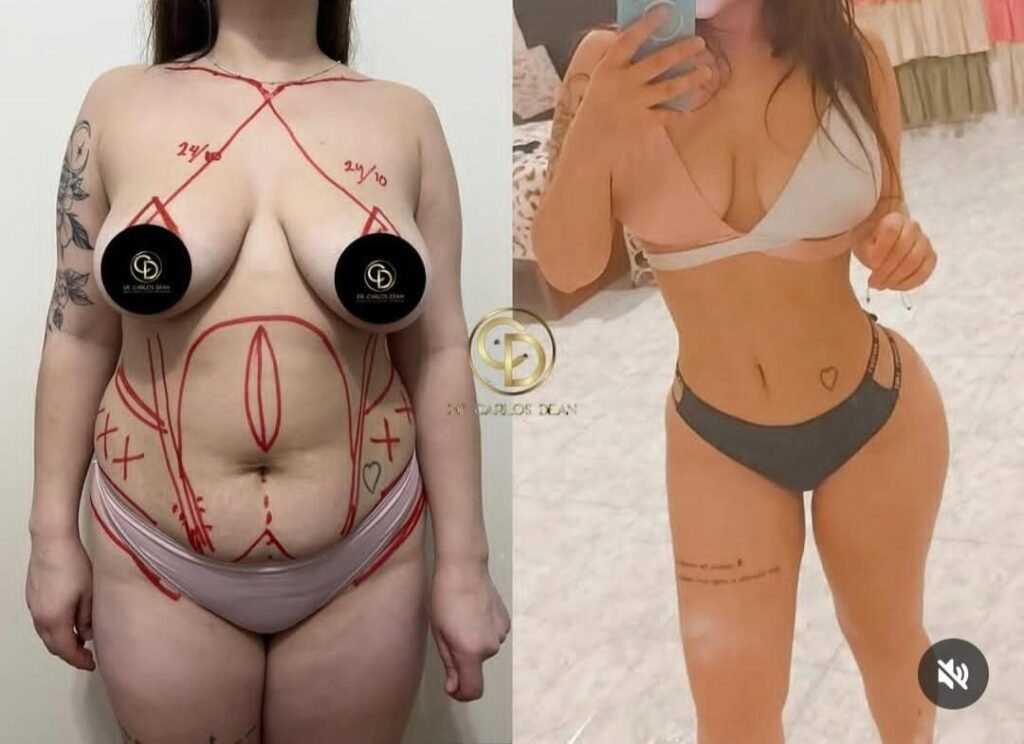 Mommy Makeover en Argentina. Dr Carlos Dean. Cirujano Plastico en Buenos Aires CABA Argentina (18)