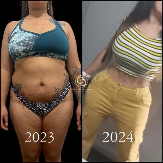 Mommy Makeover en Argentina. Dr Carlos Dean. Cirujano Plastico en Buenos Aires CABA Argentina (4)