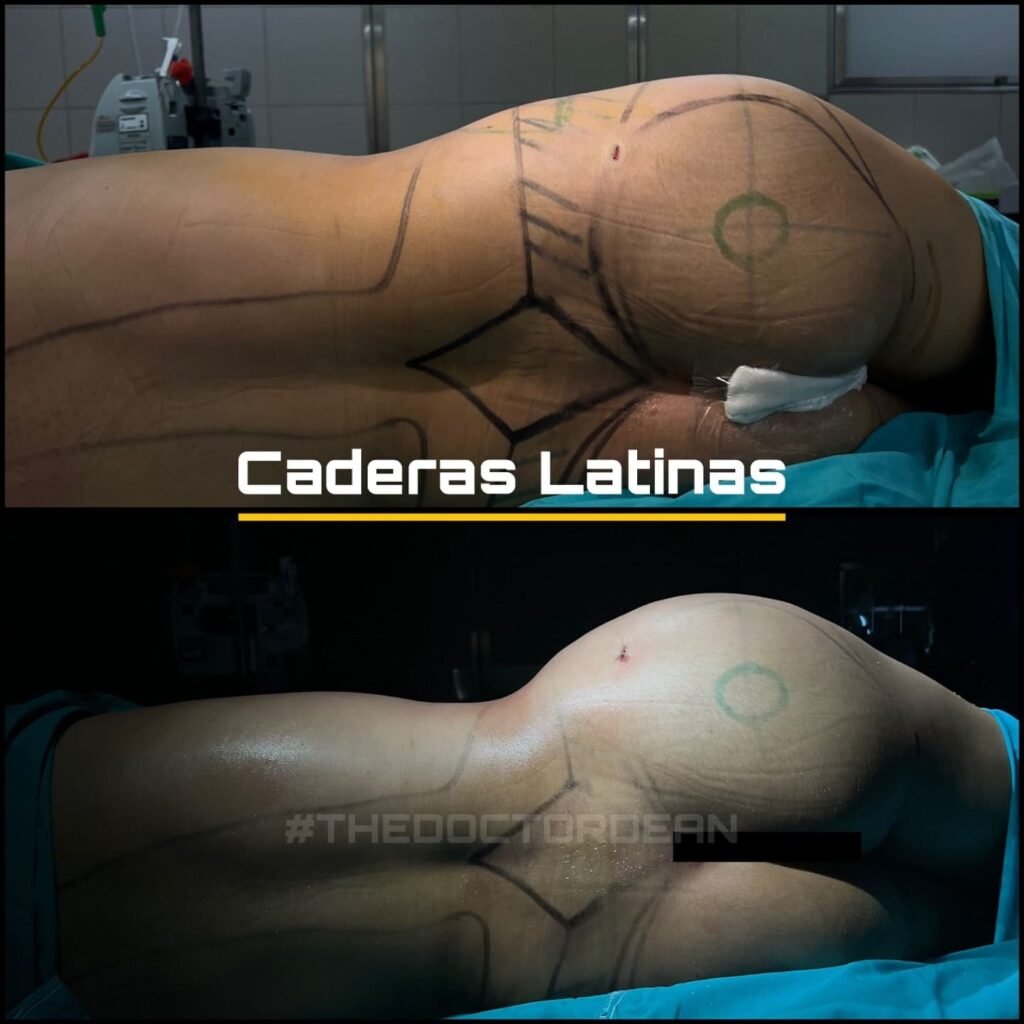 Mommy Makeover en Argentina. Dr Carlos Dean. Cirujano Plastico en Buenos Aires CABA Argentina (6)