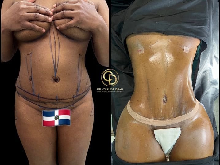 Mommy Makeover en Argentina. Dr Carlos Dean. Cirujano Plastico en Buenos Aires CABA Argentina (9)