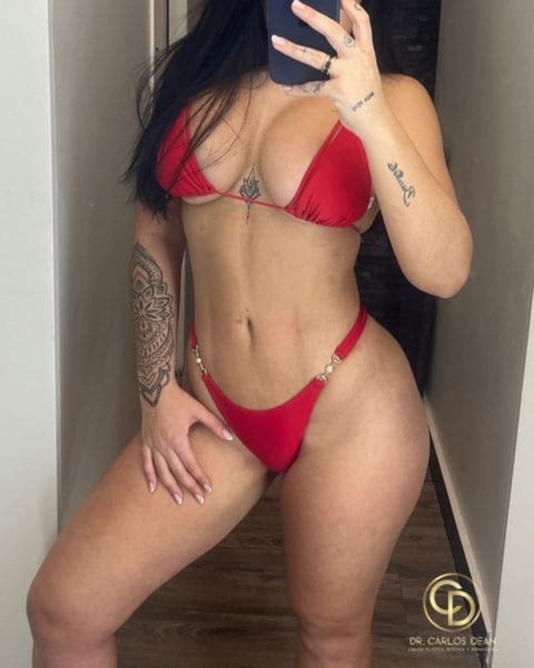 Mommy Makeover en Argentina. Dr Carlos Dean. Cirujano Plástico en CABA Buenos Aires Argentina (2)