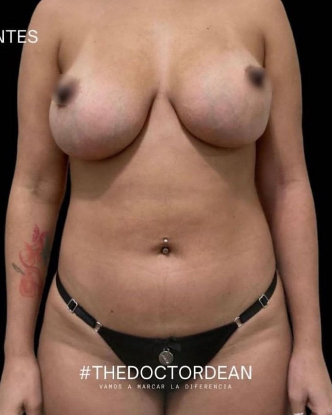 Mommy Makeover en Argentina. Dr Carlos Dean. Cirujano Plástico en CABA Buenos Aires Argentina (3)