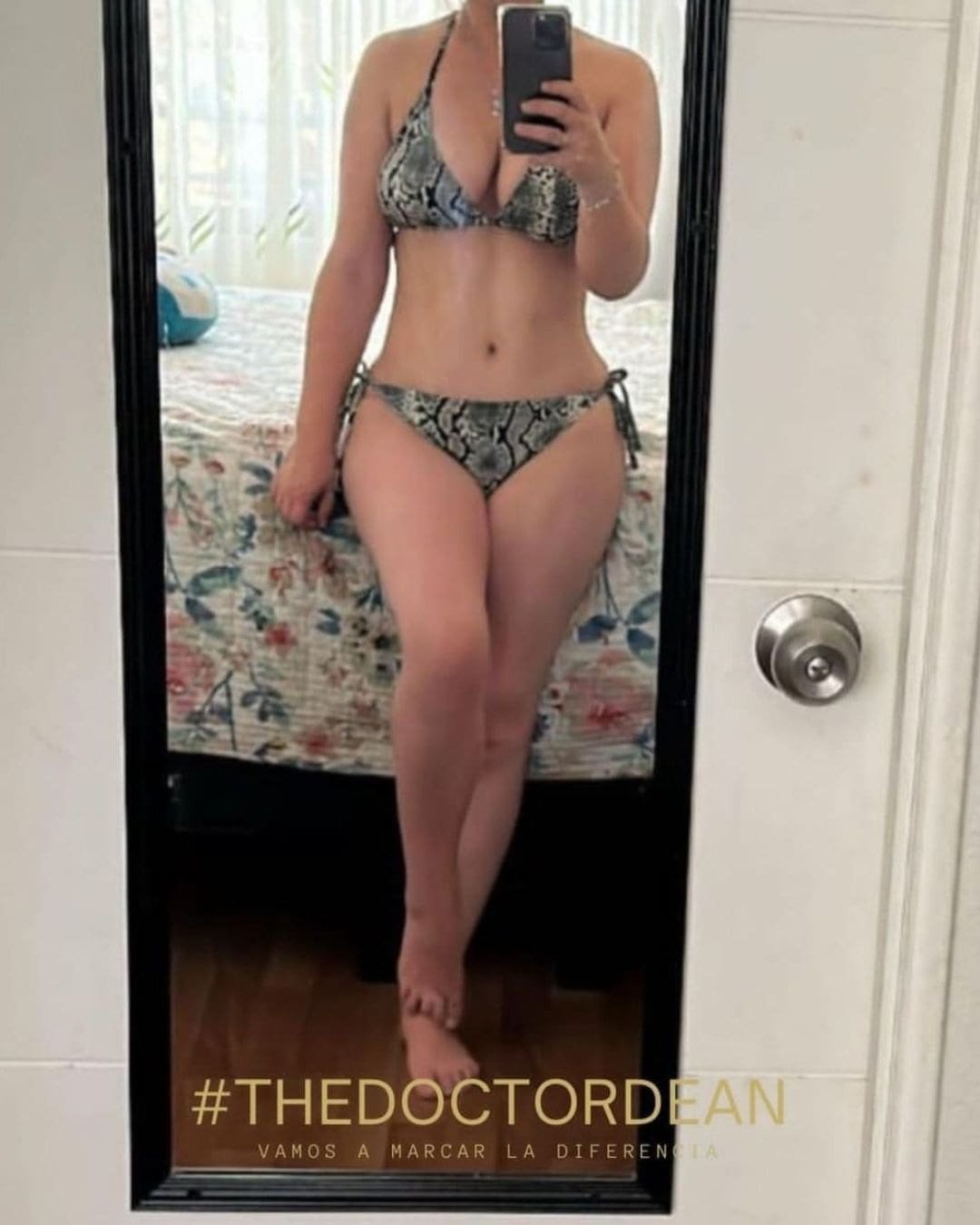 Mommy Makeover en Argentina. Dr Carlos Dean. Cirujano Plástico en CABA Buenos Aires Argentina (4)