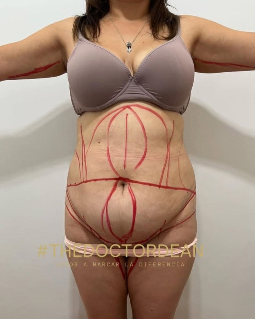 Mommy Makeover en Argentina. Dr Carlos Dean. Cirujano Plástico en CABA Buenos Aires Argentina (5)